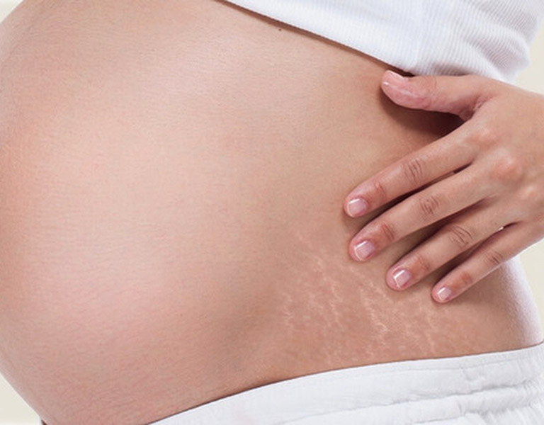 Rạn da là tình trạng khá phổ biến ở chị em phụ nữ, nhiều nhất là trong quá trình mang thai và sau khi sinh
