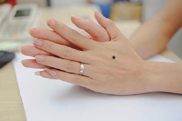 Nốt ruồi ở mu bàn tay trái – phải là hên hay xui?-2