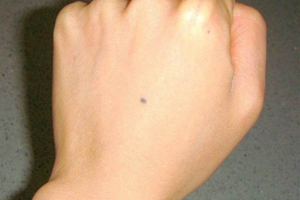 Nốt ruồi ở mu bàn tay trái – phải là hên hay xui?-1