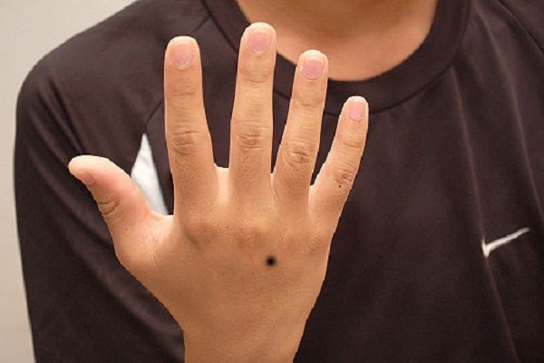 Nốt ruồi ở mu bàn tay trái – phải là hên hay xui?-3