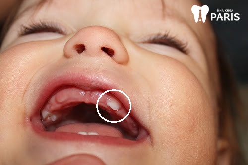 răng nanh ở trẻ sơ sinh