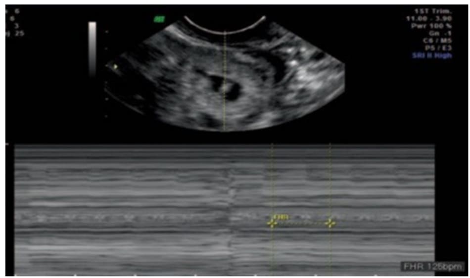 Hình 13.2 Siêu âm qua ngả âm đạo, M-mode, tại buồng trứng trái phát hiện có túi thai với tim thai (+).