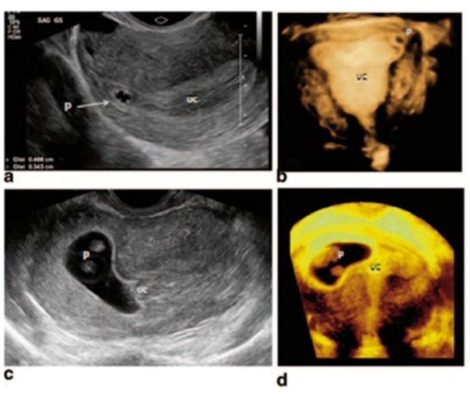 Hình 11.3 Hình ảnh TVUS với EP cho thấy khối thai (P) xuất hiện bên ngoài buồng tử cung (UC). B: 3d TVUS cho thấy thai ở sừng trái tử cung. C: tương quan vị trí khối thai và buồng tử cung và D: 3D TVUS xác nhận thai nằm trong mô kẽ (P).