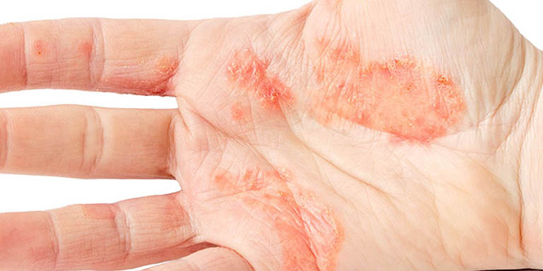 Tỷ lệ người bệnh bị nổi mẩn ngứa lòng bàn tay do lupus ban đỏ vô cùng thấp