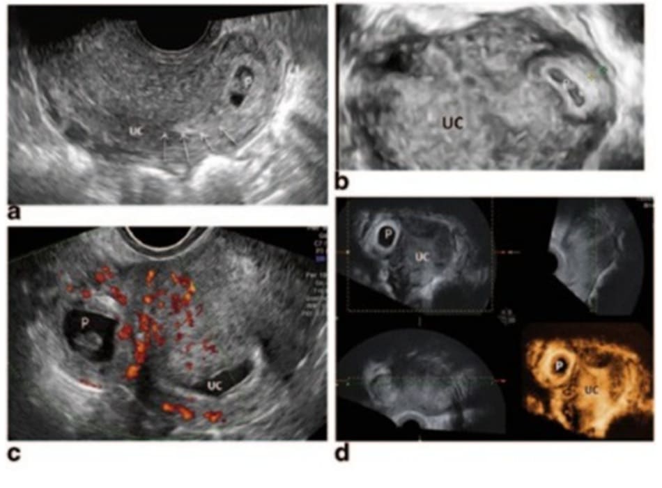 Hình 11.1 Siêu âm qua ngả âm đạo. A: Buồng tử cung rỗng (UC) với một đường tăng âm (mũi tên) hướng tới túi thai (P). B: Siêu âm 3D cho thấy một lớp cơ tử cung mỏng đi từ buồng tử cung tới tiếp nối với túi thai (P). C: Siêu âm đánh giá tưới máu xung quanh khối thai (P). và D: Hình ảnh siêu âm 3D cho thấy một khối thai ngoài tử cung được ký hiệu là P với khoang tử cung rỗng (UC).