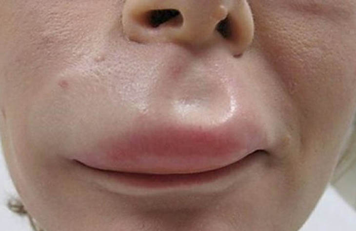 Nổi mề đay sưng môi gây không ít phiền toái cho sinh hoạt của người bệnh