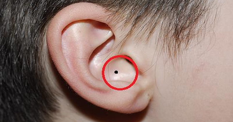 Nốt ruồi nằm bên trong tai