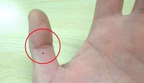 nốt ruồi ở ngón tay cái